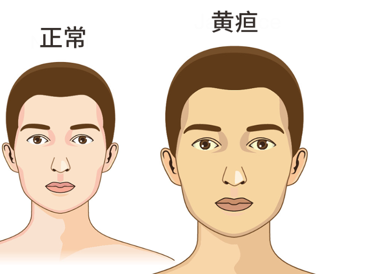 黄疸两个月了还没退怎么办 